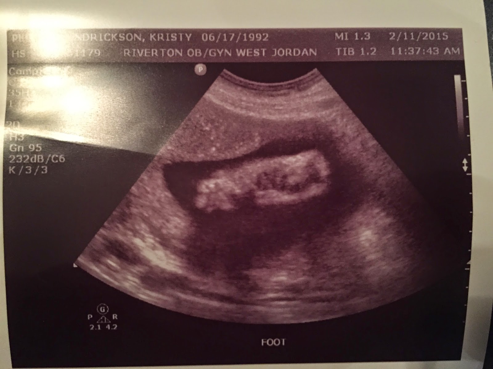 low amniotic fluid at 38 weeks low amniotic fluid at 38 weeks